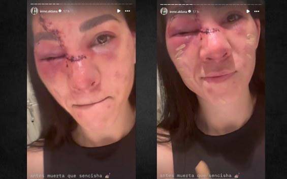 ¡Impactante! Así quedó el rostro de Irene Aldana tras pelea de UFC contra Dumont